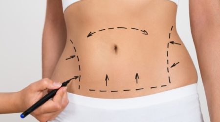 Abdominoplastie Tunisie - Lifting du ventre